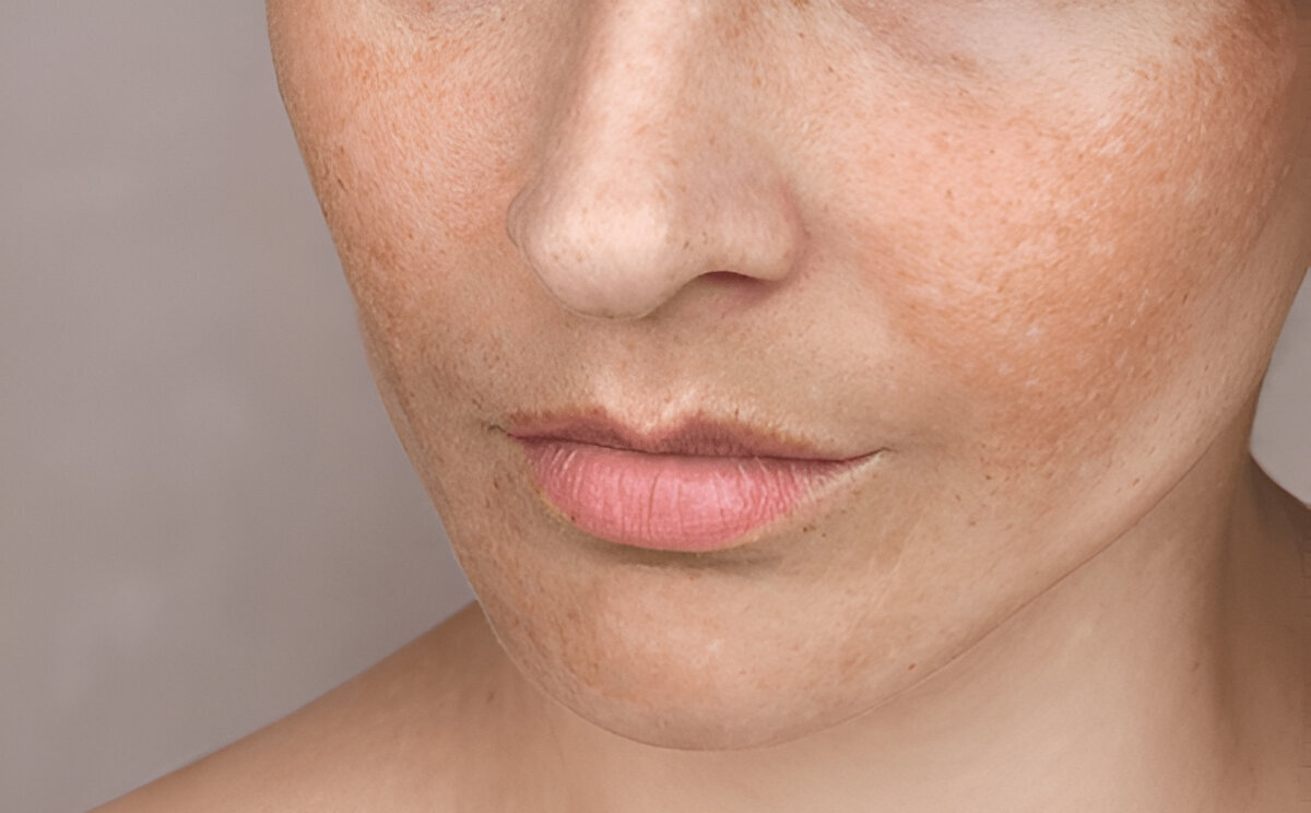 How To Get Rid of Skin Texture ASAP?